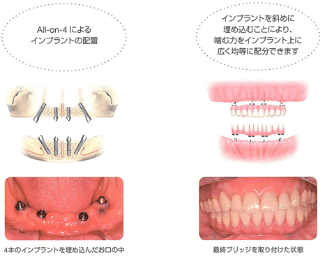 all-on-4によるインプラントの配置 インプラント斜めに埋め込むことにより、嚙む力をインプラント上に広く均等に配分出来ます。