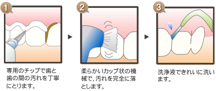 専用のチップで歯と歯の間の汚れを丁寧にとります。柔らかいカップ状の機械で、汚れを完全に落とします。洗浄液できれいに洗います。